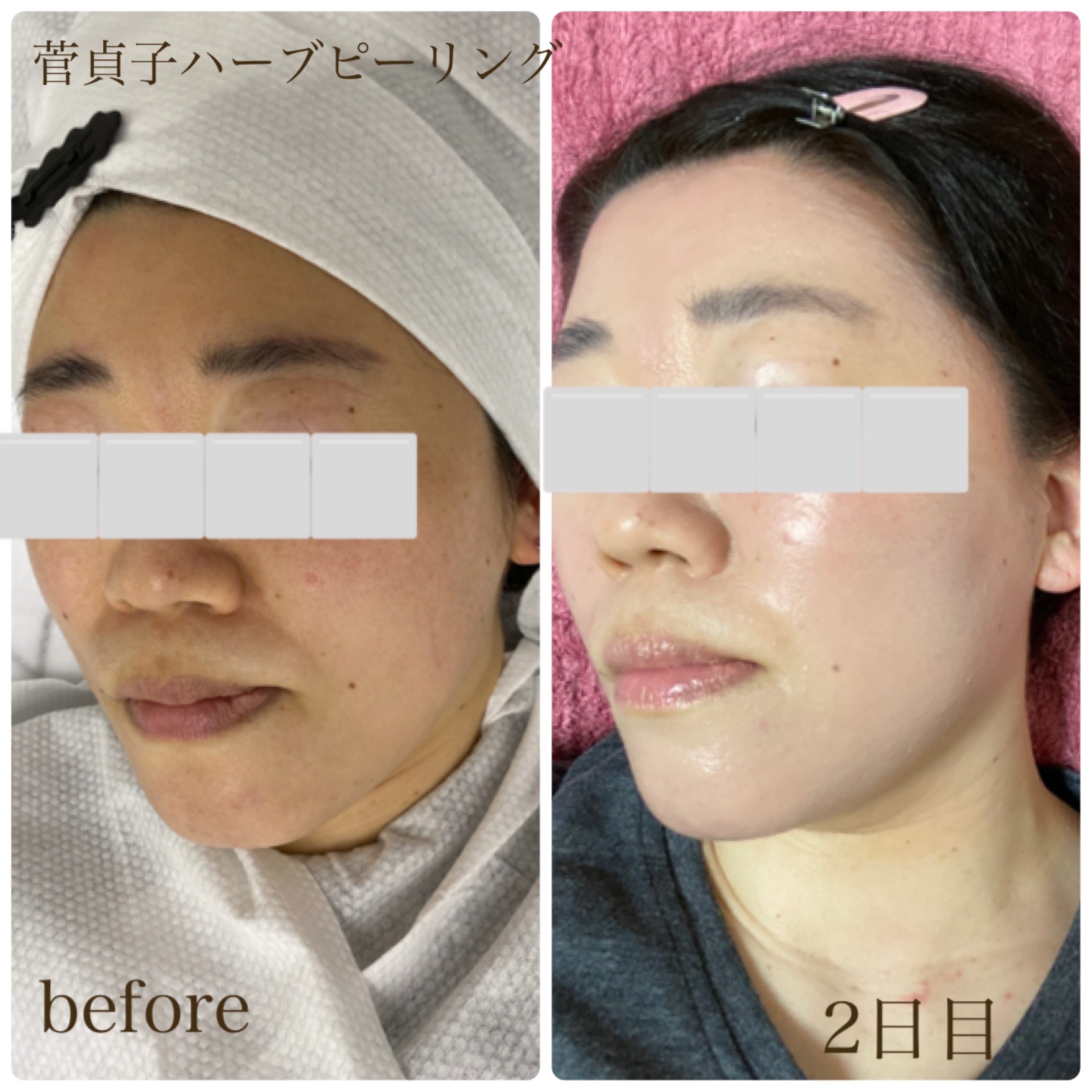 限定セール！！菅貞子ハーブピーリング